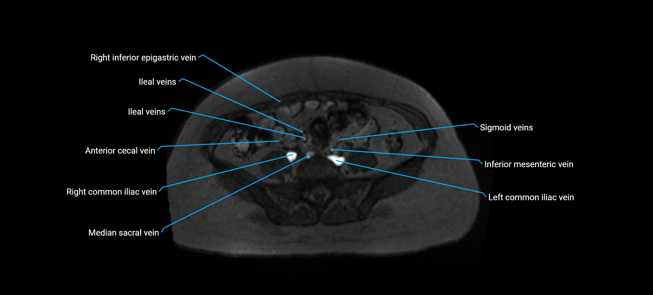 MRV abdomen pelvis & lower limb axial cross sectional anatomy labelled MRI image 127 (1).webp